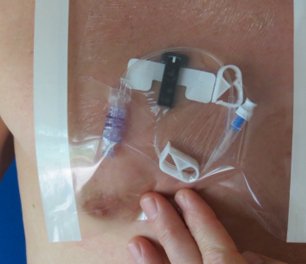 HydroSeal Wound Protector, Medium, 1 Box of 14 (General Wound Care) - Img 2